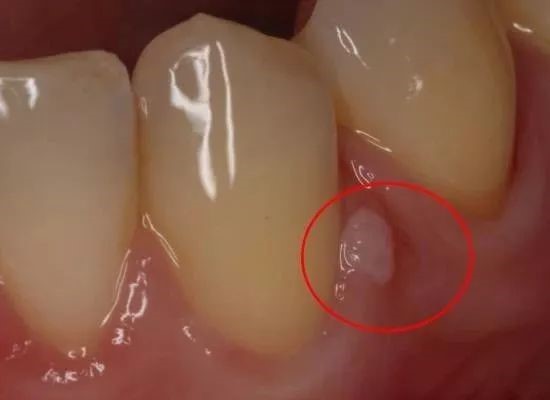 牙龈上长脓包，挤掉后还反复长出怎么回事？