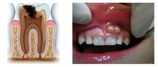 牙龈出现白脓包以为只是发炎吗？—义乌口腔医院