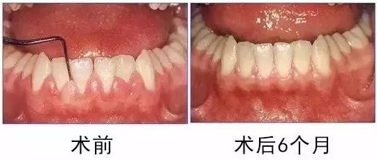 牙龈出现白脓包以为只是发炎吗？—义乌口腔医院