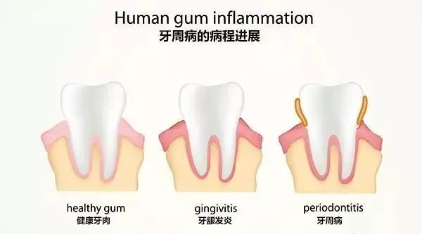 年轻人，比脱发更可怕的是牙坏了！