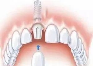 种植牙会和真牙一样坚固耐用吗？