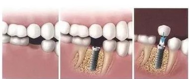 种植牙会与身体产生排斥吗？