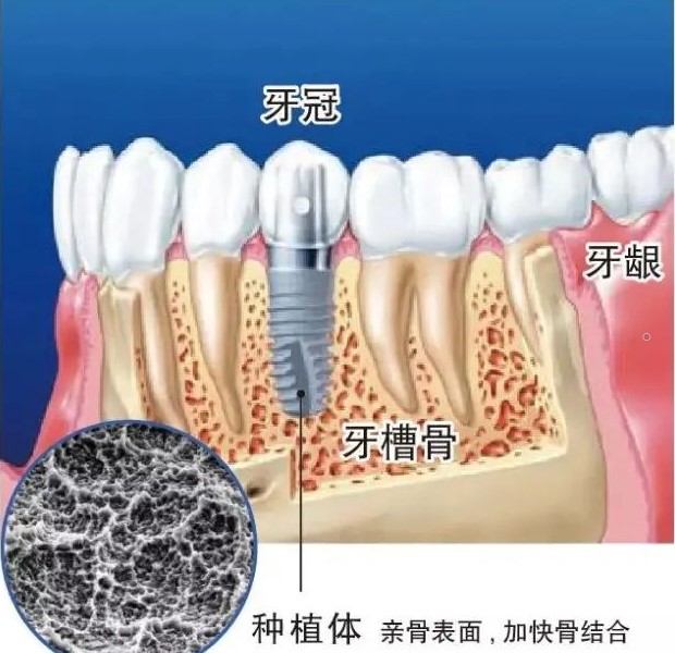 种植牙会与身体产生排斥吗？