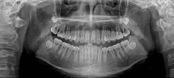 口腔全景片到底有何用？—义乌口腔医院