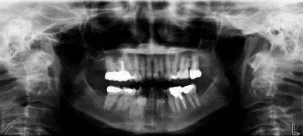 口腔全景片到底有何用？—义乌口腔医院