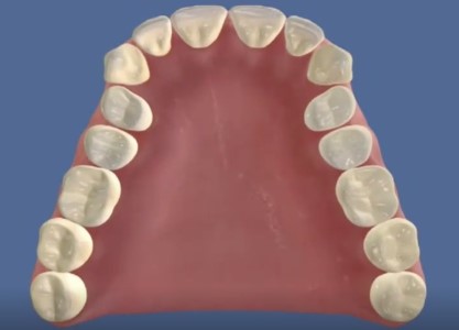 不拔牙，牙齿矫正除了片切还有其他吗？—义乌傅氏口腔