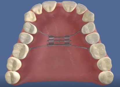 不拔牙，牙齿矫正除了片切还有其他吗？—义乌傅氏口腔