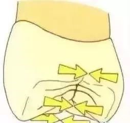 如何把握嵌体与高嵌体？