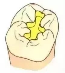 如何把握嵌体与高嵌体？