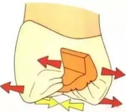 如何把握嵌体与高嵌体？