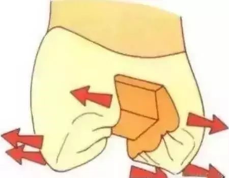 如何把握嵌体与高嵌体？