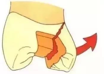 如何把握嵌体与高嵌体？