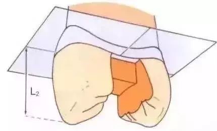 如何把握嵌体与高嵌体？