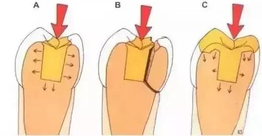 如何把握嵌体与高嵌体？