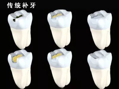 嵌体是比补牙更好的选择！