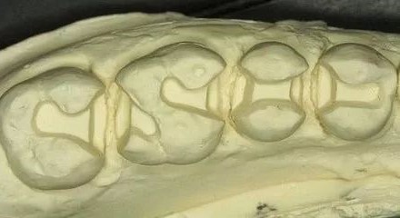 嵌体是比补牙更好的选择！