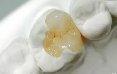 嵌体是比补牙更好的选择！