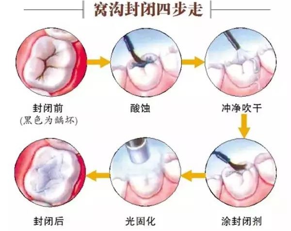 浅龋、中龋补牙就可以,深龋牙髓炎要怎么办?—义乌傅氏口腔 浅龋、中龋补牙就可以,深龋牙髓炎要怎么办?—义乌傅氏口腔