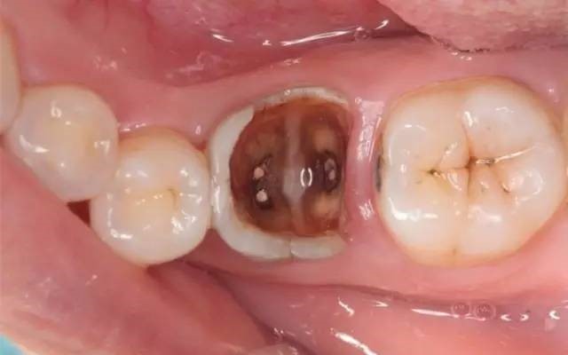 残冠残根 残冠残根