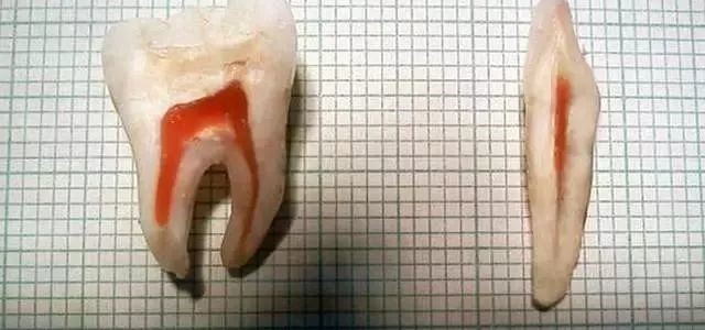 基础的根管彻底清理操作!—义乌傅氏口腔 基础的根管彻底清理操作!—义乌傅氏口腔