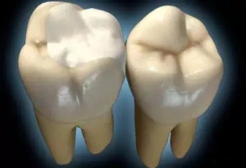 补牙为何要选嵌体，来看嵌体的优势！—义乌口腔修复
