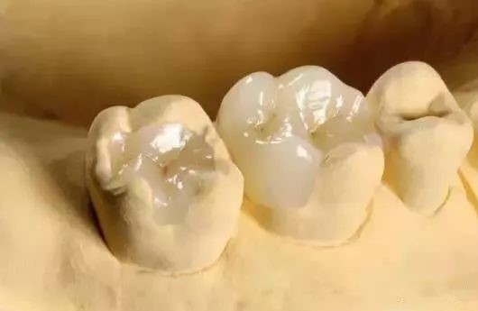 补牙为何要选嵌体，来看嵌体的优势！—义乌口腔修复