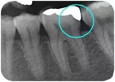 补牙为何要选嵌体，来看嵌体的优势！—义乌口腔修复