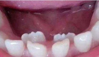 如果有这七种牙齿，赶紧拔了吧！—义乌傅氏口腔