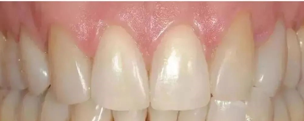 全瓷牙与烤瓷牙材料相差很大,效果也是不同!—义乌傅氏口腔 全瓷牙与烤瓷牙材料相差很大,效果也是不同!—义乌傅氏口腔