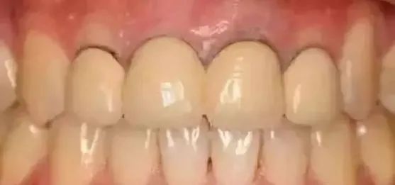 全瓷牙与烤瓷牙材料相差很大,效果也是不同!—义乌傅氏口腔 全瓷牙与烤瓷牙材料相差很大,效果也是不同!—义乌傅氏口腔