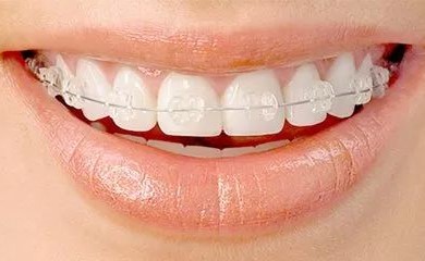 隐形牙套、钢托槽、陶瓷托槽有何区别? 隐形牙套、钢托槽、陶瓷托槽有何区别?