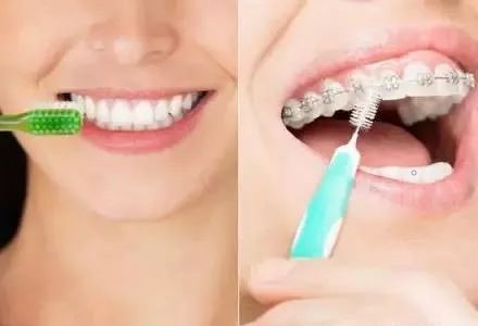 隐形牙套、钢托槽、陶瓷托槽有何区别? 隐形牙套、钢托槽、陶瓷托槽有何区别?