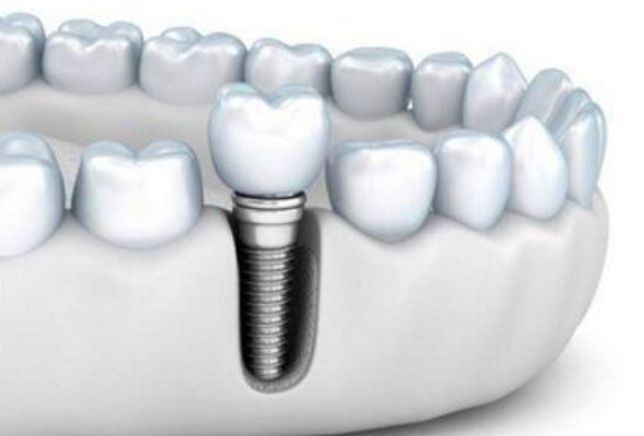 怎样使缺失多颗的牙齿快速修复—义乌傅氏口腔 怎样使缺失多颗的牙齿快速修复—义乌傅氏口腔