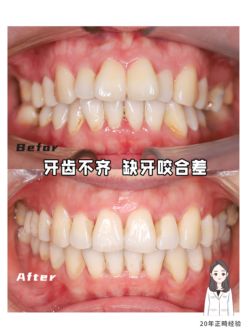 义乌傅氏口腔牙齿不齐、缺牙、咬合差矫正案例分享！