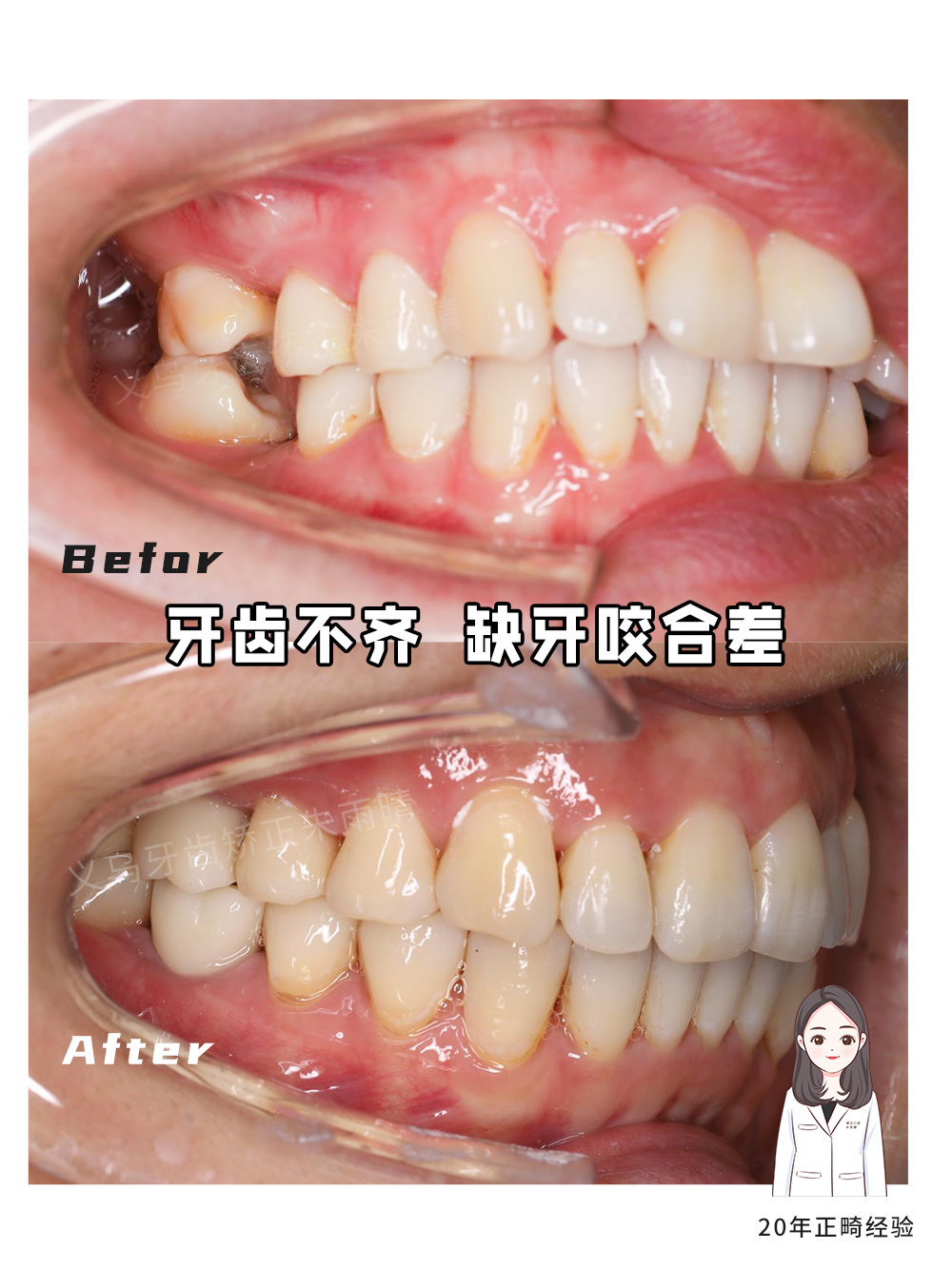 义乌傅氏口腔牙齿不齐、缺牙、咬合差矫正案例分享！