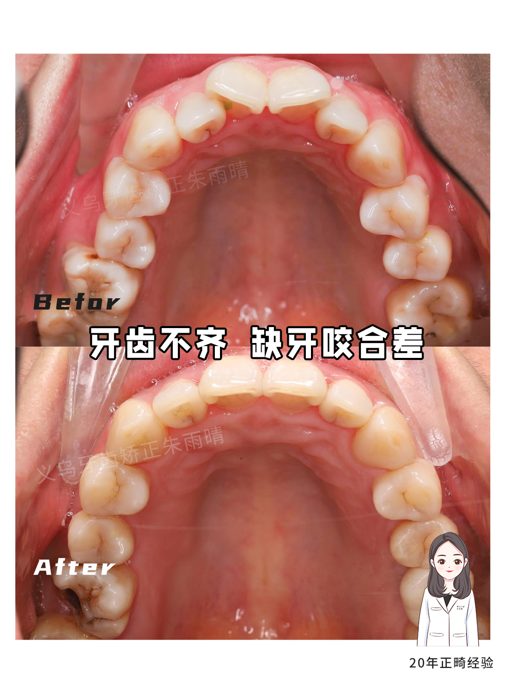 义乌傅氏口腔牙齿不齐、缺牙、咬合差矫正案例分享！