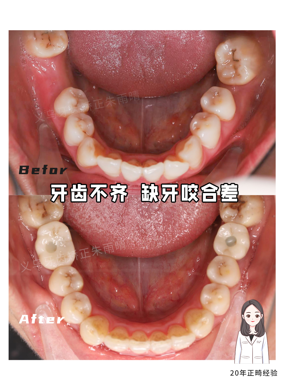 义乌傅氏口腔牙齿不齐、缺牙、咬合差矫正案例分享！