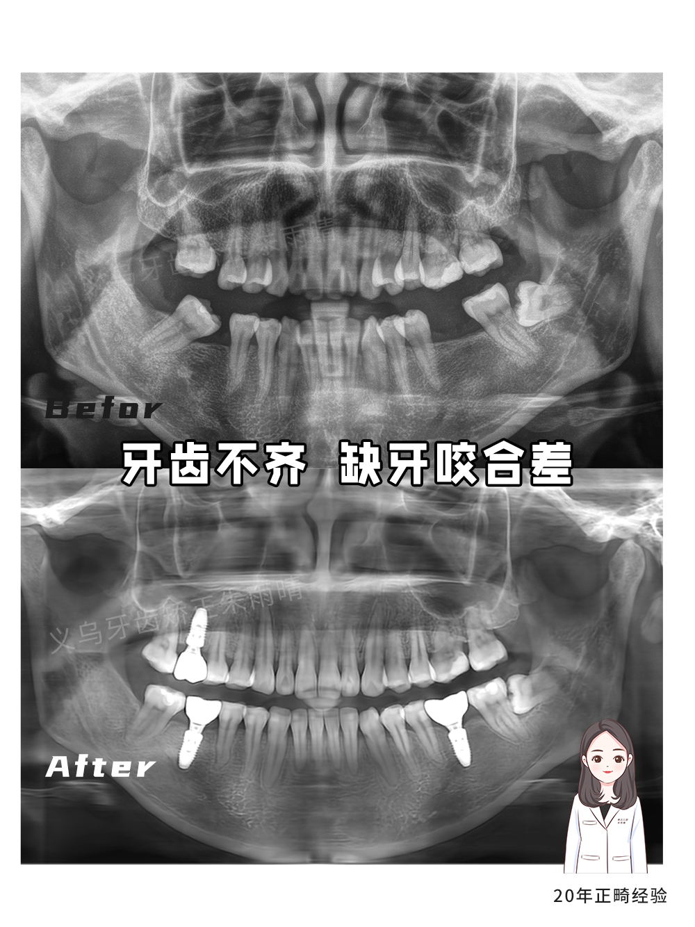 义乌傅氏口腔牙齿不齐、缺牙、咬合差矫正案例分享！