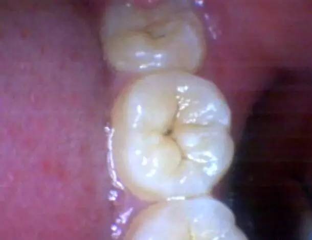 窝沟龋:这种情况需要补牙吗?—义乌傅氏口腔 窝沟龋:这种情况需要补牙吗?—义乌傅氏口腔