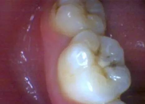 窝沟龋:这种情况需要补牙吗?—义乌傅氏口腔 窝沟龋:这种情况需要补牙吗?—义乌傅氏口腔