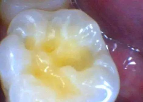 窝沟龋:这种情况需要补牙吗?—义乌傅氏口腔 窝沟龋:这种情况需要补牙吗?—义乌傅氏口腔