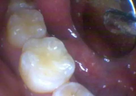 窝沟龋:这种情况需要补牙吗?—义乌傅氏口腔 窝沟龋:这种情况需要补牙吗?—义乌傅氏口腔