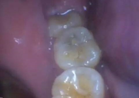 窝沟龋:这种情况需要补牙吗?—义乌傅氏口腔 窝沟龋:这种情况需要补牙吗?—义乌傅氏口腔