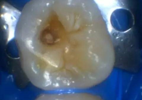 窝沟龋:这种情况需要补牙吗?—义乌傅氏口腔 窝沟龋:这种情况需要补牙吗?—义乌傅氏口腔