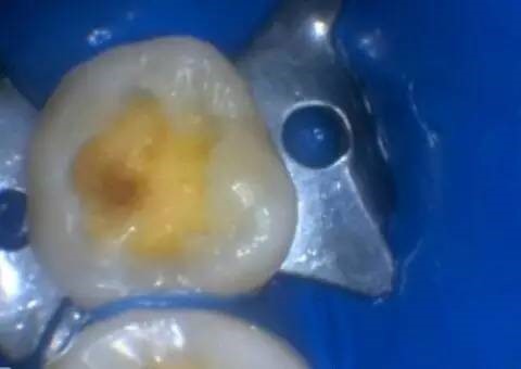 窝沟龋:这种情况需要补牙吗?—义乌傅氏口腔 窝沟龋:这种情况需要补牙吗?—义乌傅氏口腔