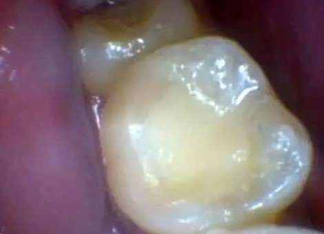 窝沟龋:这种情况需要补牙吗?—义乌傅氏口腔 窝沟龋:这种情况需要补牙吗?—义乌傅氏口腔