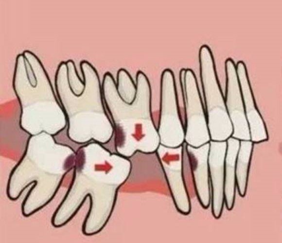 孩子乳牙龋坏怎么办? 孩子乳牙龋坏怎么办?