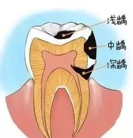 浅龋、中龋补牙就可以了，深龋要怎么办？