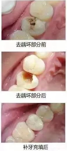 浅龋、中龋补牙就可以了，深龋要怎么办？