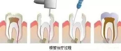 浅龋、中龋补牙就可以了，深龋要怎么办？